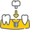 Dental Implant Icon